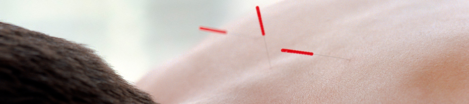 Acupuncture